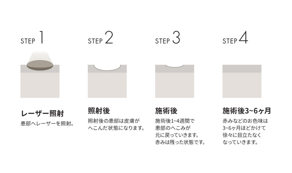 ほくろやいぼの除去治療の流れ