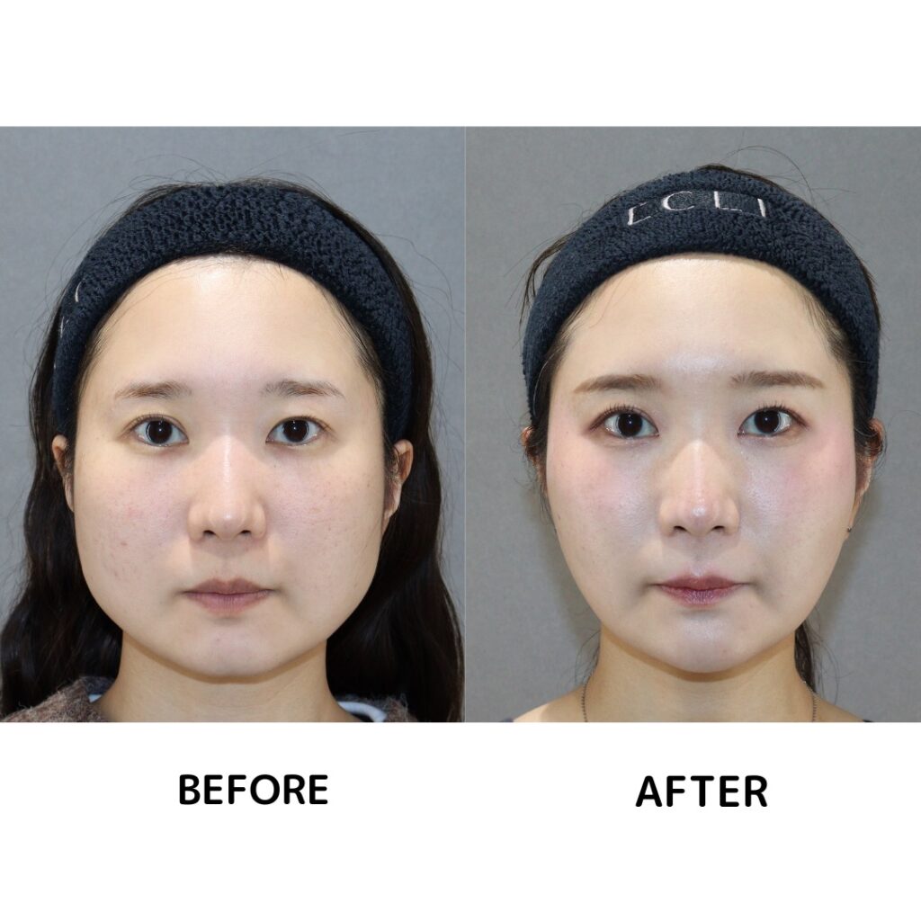 症例写真 ヒアルロン酸注射00001