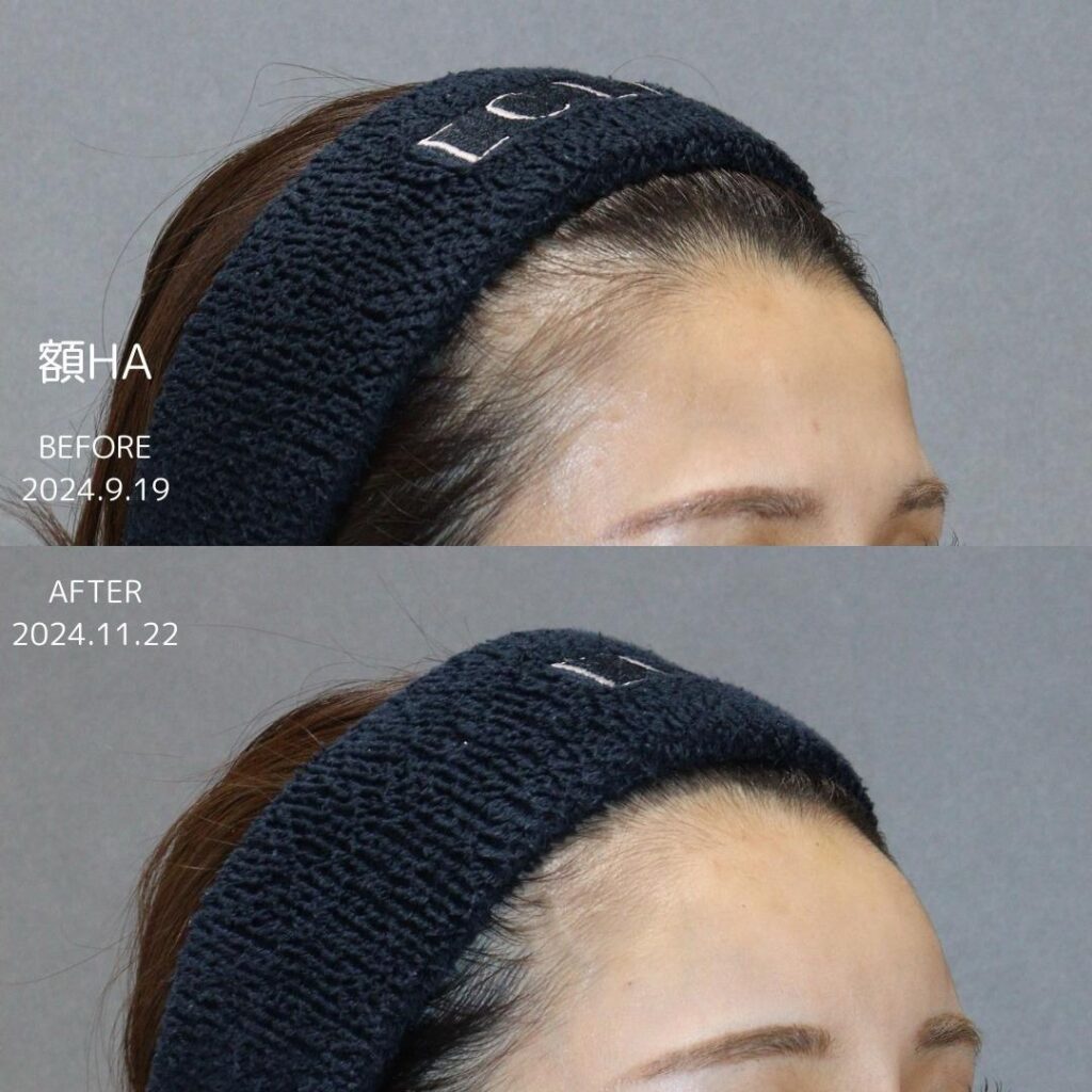 症例写真 ヒアルロン酸注射00002