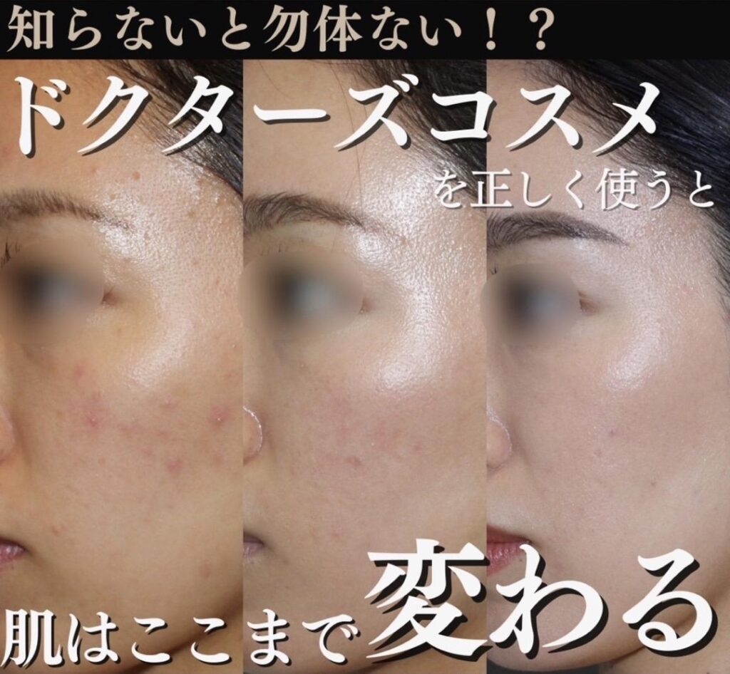 症例写真 ゼオスキン 02