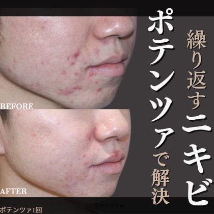 症例写真 ポテンツァ01