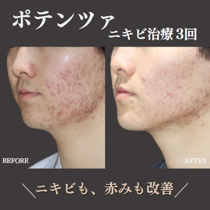 症例写真 ポテンツァ02