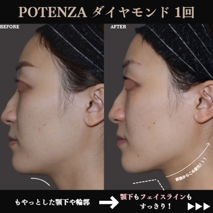 症例写真 ポテンツァ03