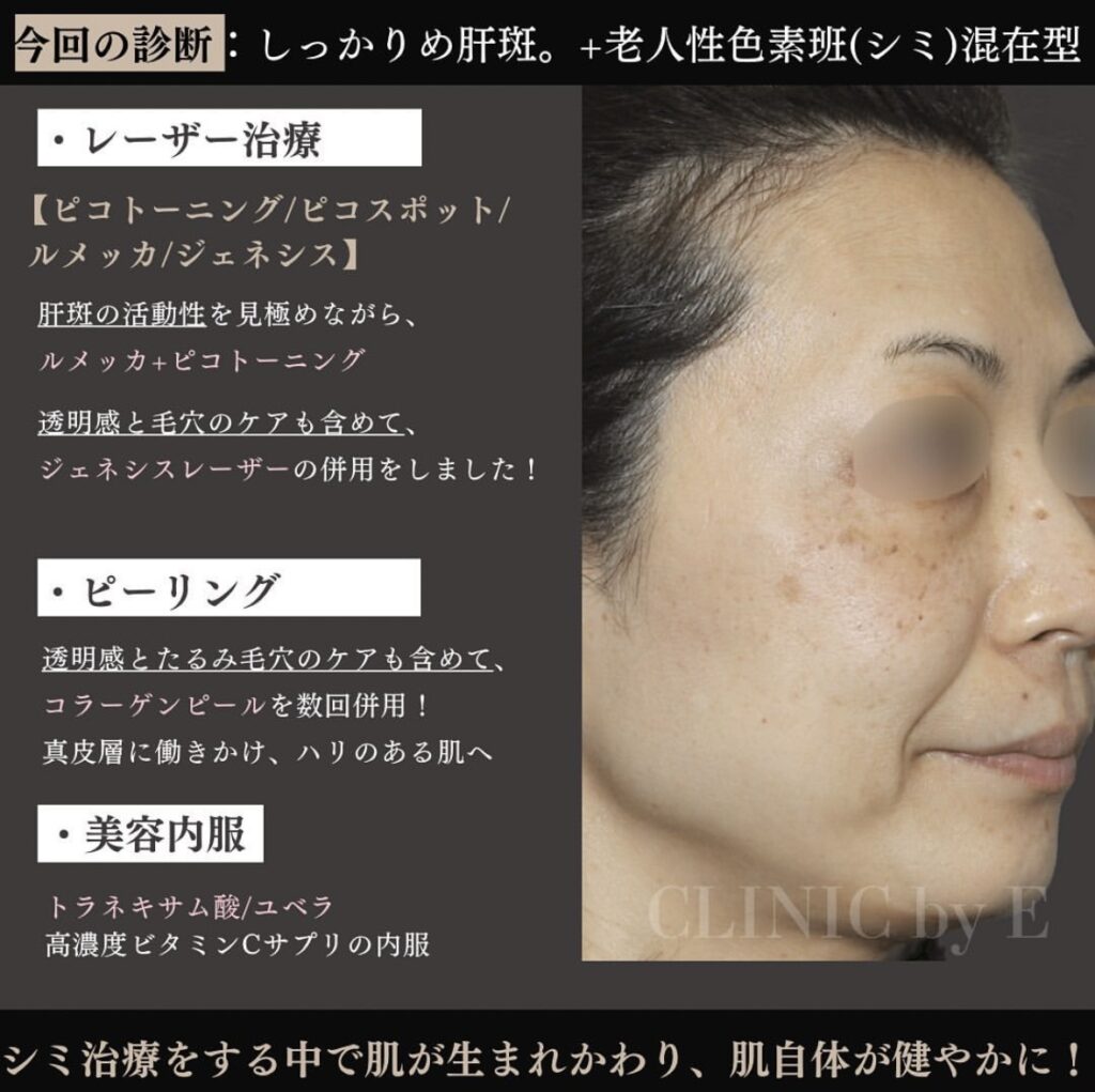 トラネキサム酸