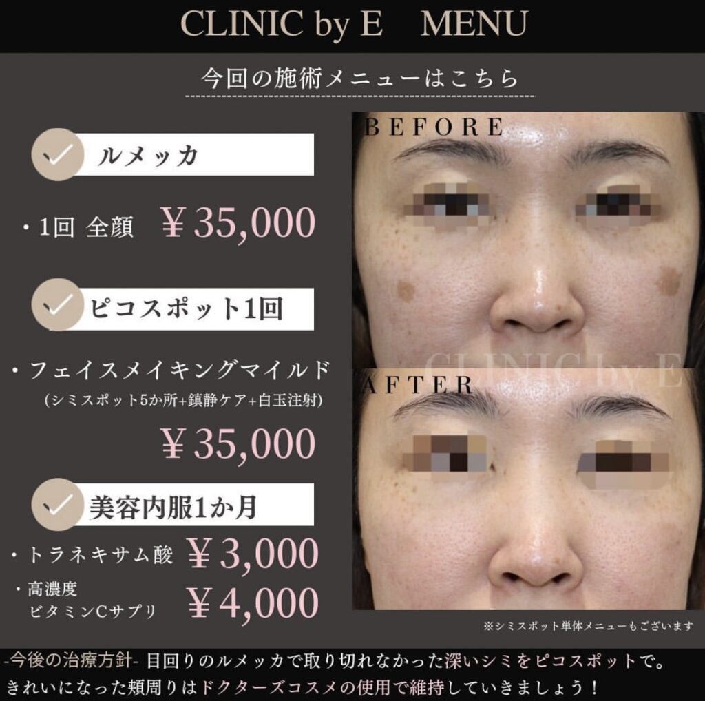 ハイドロキノン