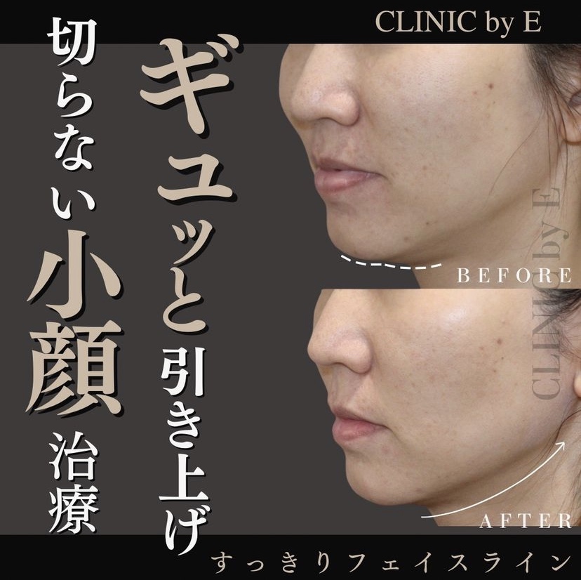 小顔治療