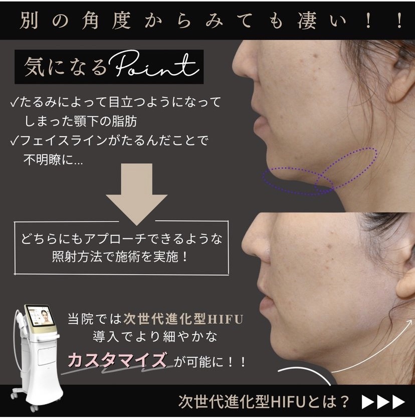 カスタマイズハイフ