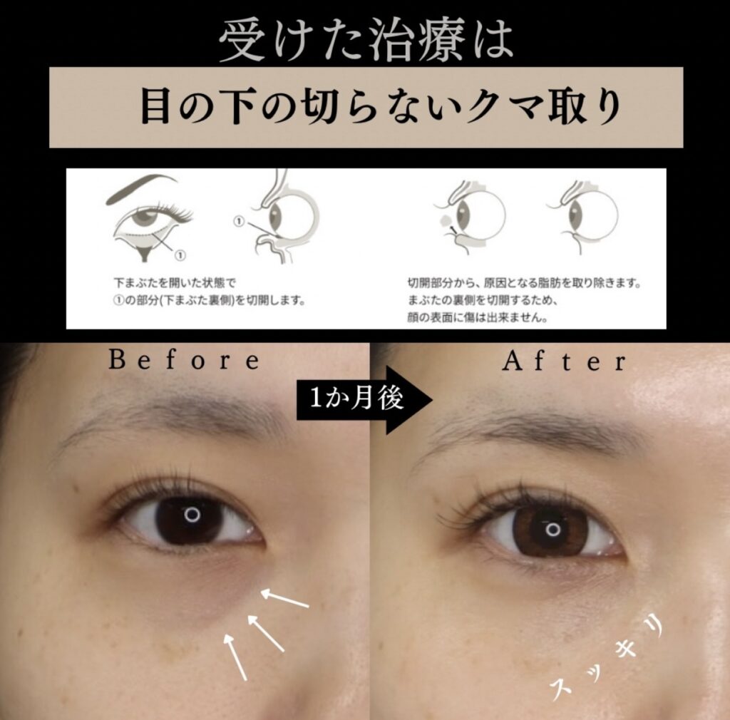 目の下の切らないクマ取り