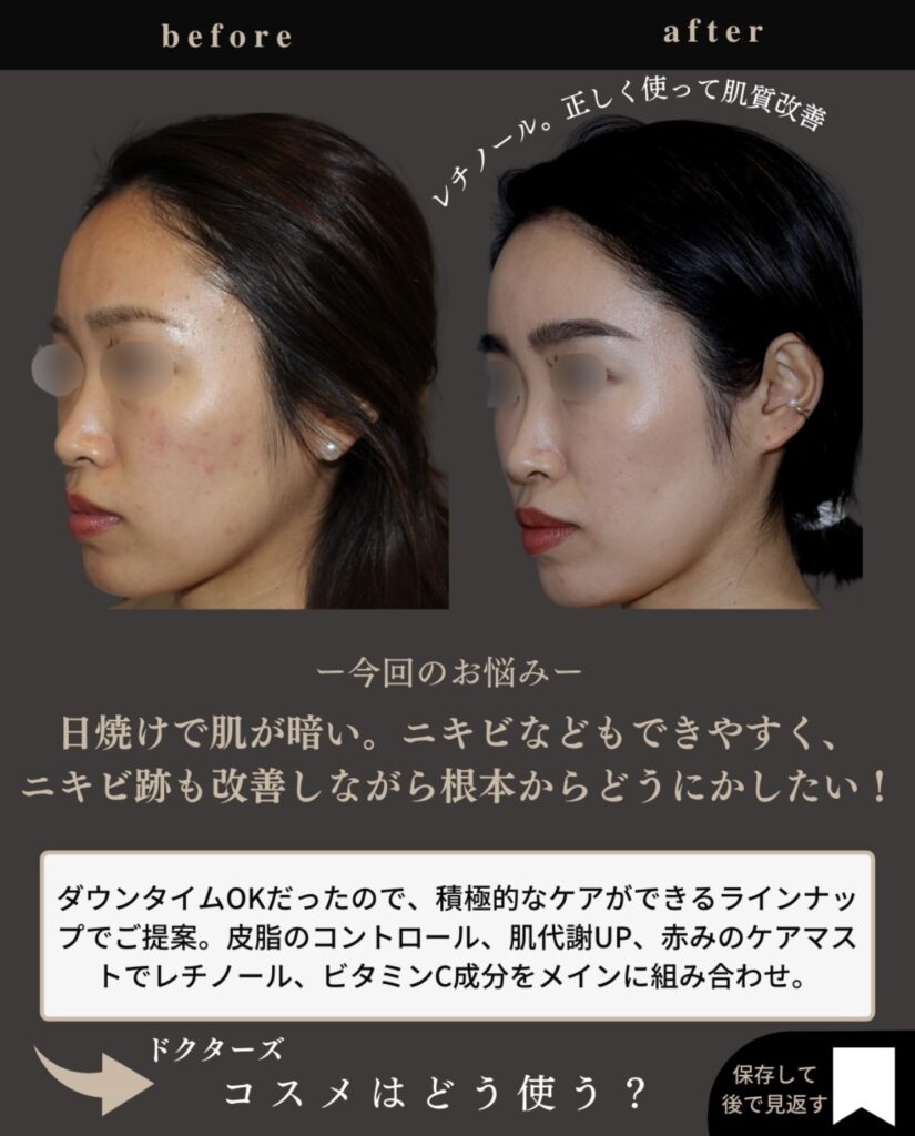 脂性肌肌質改善