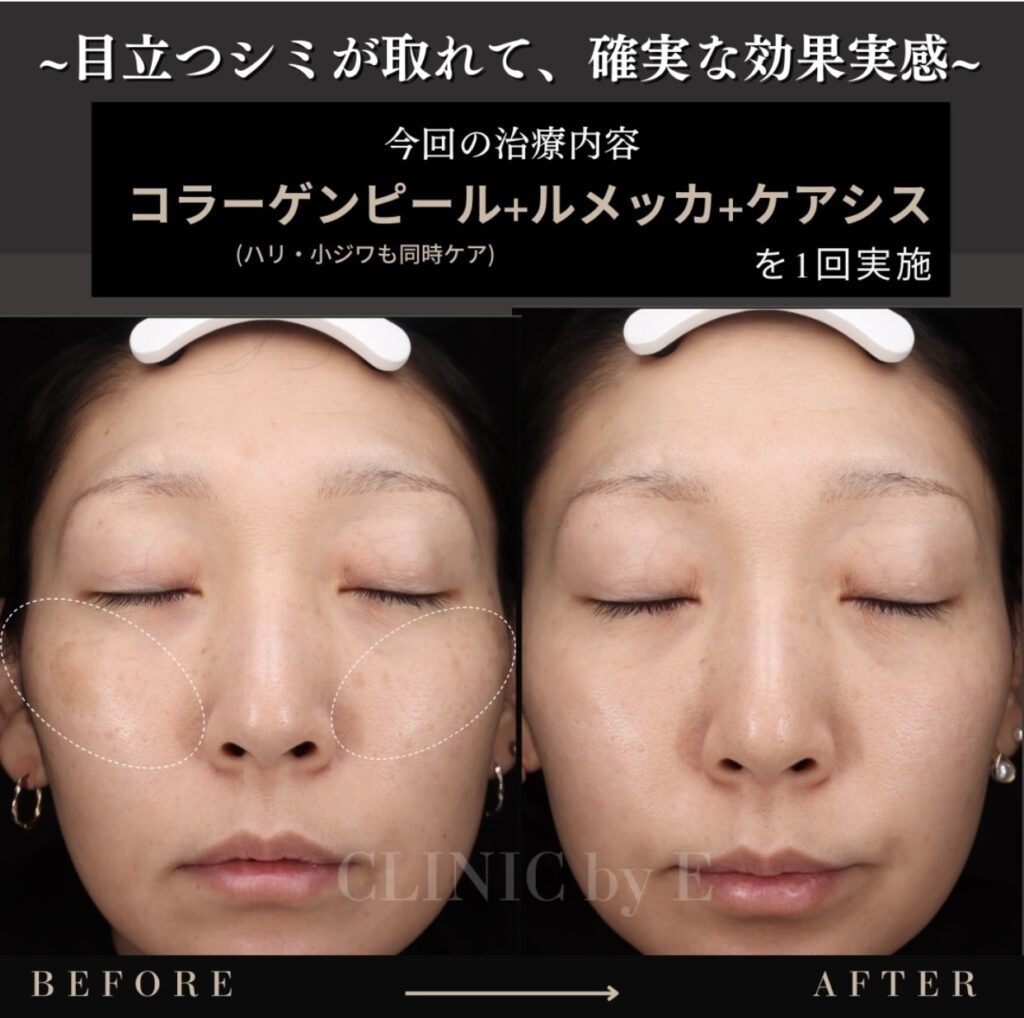 コラーゲンピールルメッカケアシス