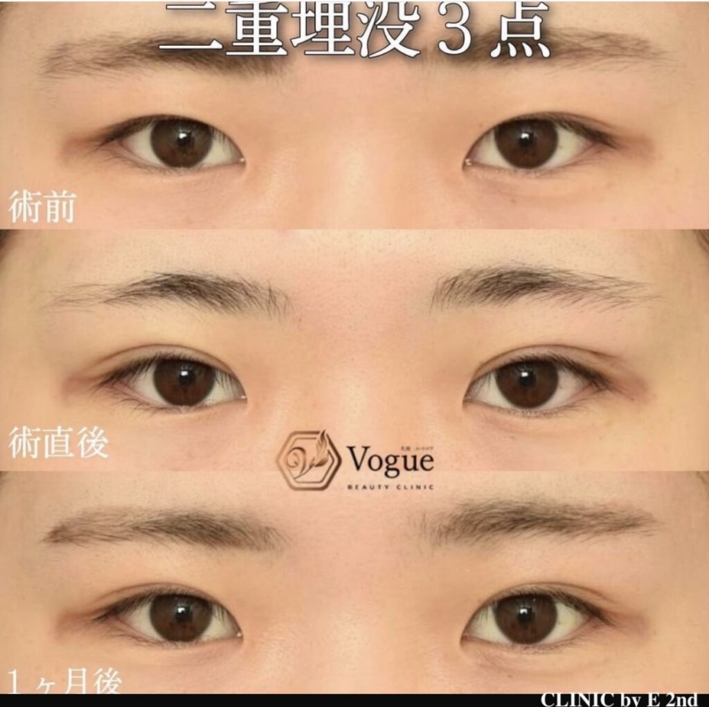 ナチュラル二重術