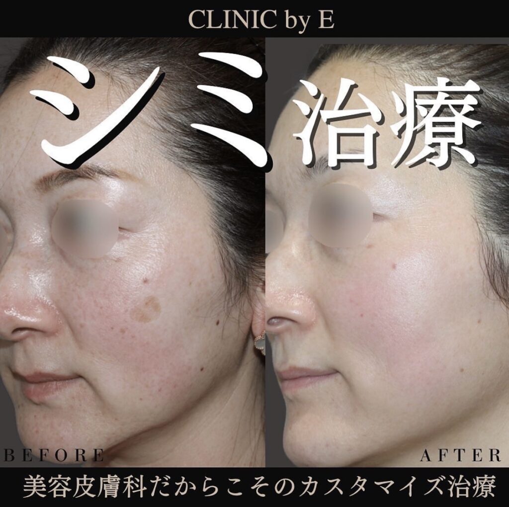 ジェネシスレーザー