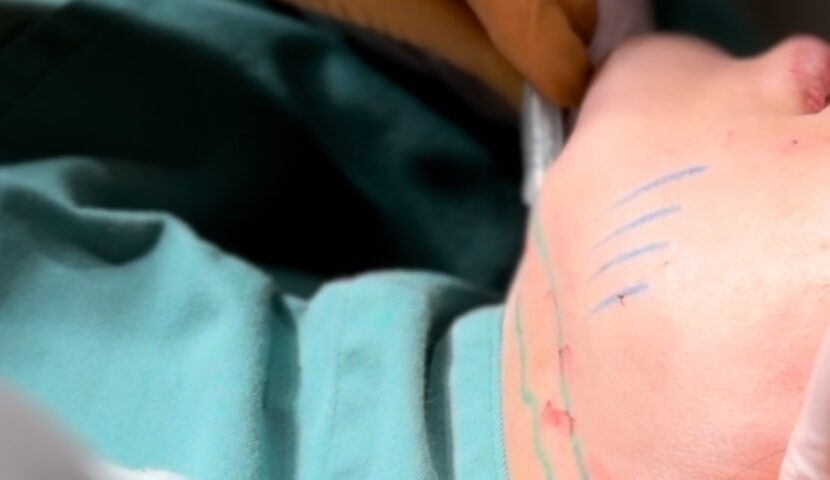 糸リフト後のボコボコの原因とは？対処法と凹みを作らないためのポイントも解説